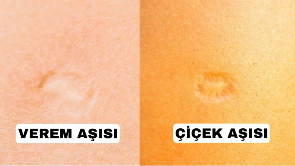 Mpox (Maymun Çiçeği Virüsü) ve Çiçek Aşısının Önemi